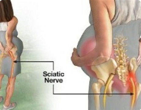 sciatica  nerve pain