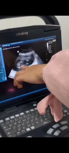 Jk janin 20 week