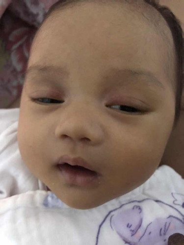 PULA SA EYELID