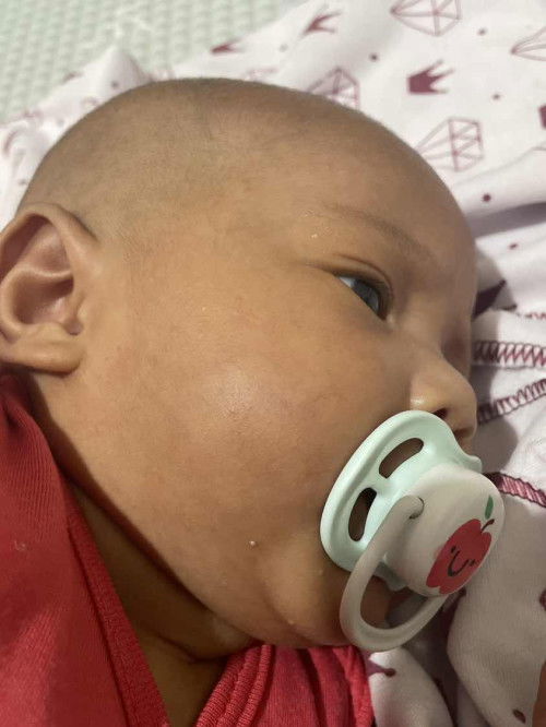 Milia pada bayi 1 bulan 22 hari