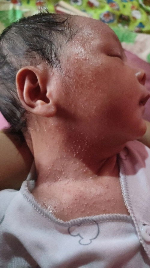 Bruntusan pada bayi 10hari 
Ada yg tau bund cara ngilanginnya gmna?