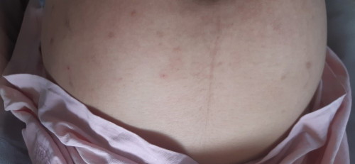 ผดขึ้นเต็มท้องเลยแม่คนไหนเป็นบ้าง