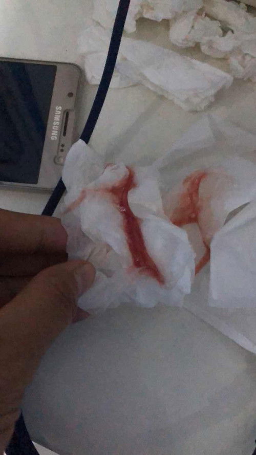 Sudah mengeluarkan lendir darah