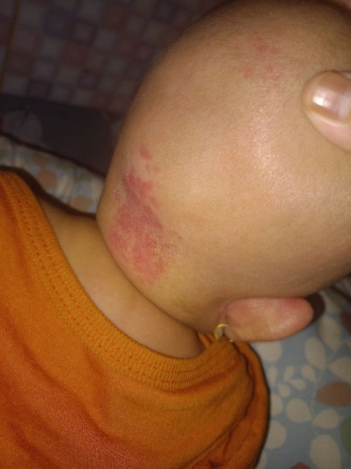 Kepala belakang bayi merah