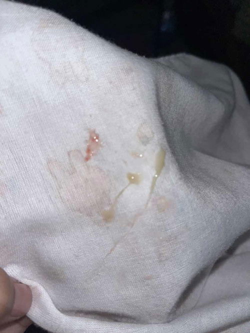 ดูดน้ำมูกมีเลือดปน