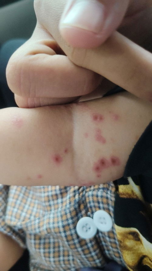 Kulit bayi merah gatal dan berair