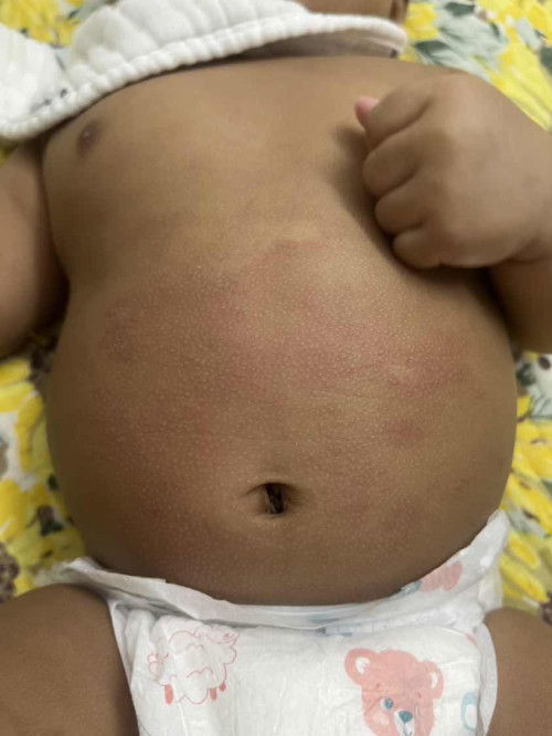 Hi mommies.. baby sy 4bulan naik merah-merah mcm ni, adakah dikira eczema?