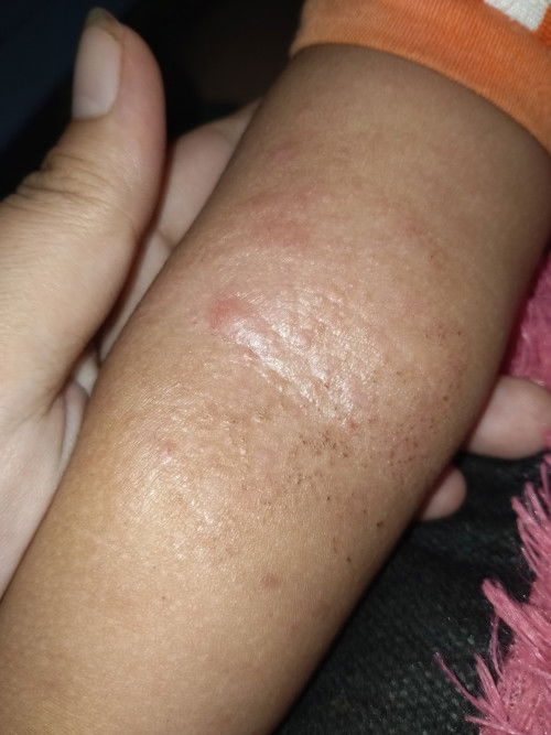 Obat gatal anak apa ya Bun ?