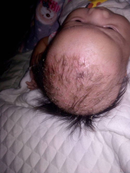 เป็นไขที่หัว