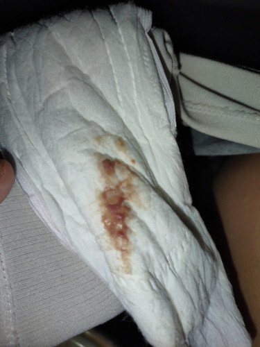 หลังผ่าคลอดได้2เดือนน้ำคาวปลาพึ่งหมดจู่ๆมีตกขาวเป็นเลือดแบบนี้ปกติมั้ยคะใครเคยเป็นบ้างรึไม่ใช่ตกขาว