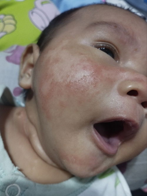 Baby Acne po ba ito.