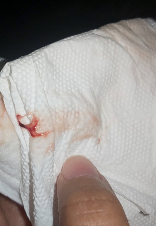 Vaginal Discharge