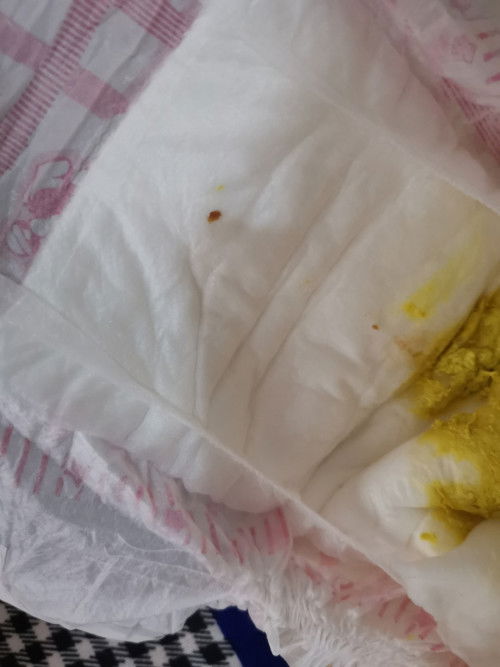 Blood in poop formula feed 1 month old baby