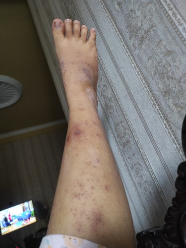bun mau tanya apakah ini scabies apa bukan ya?