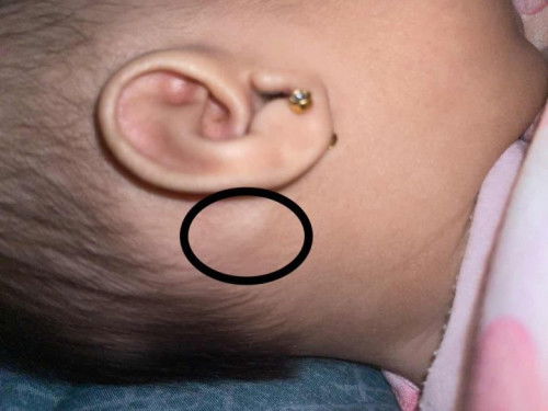 Benjolan di telinga bayi