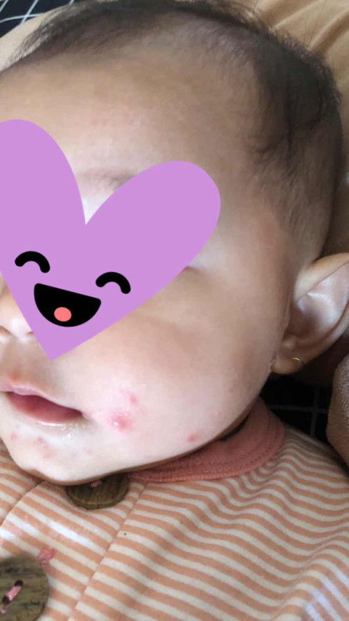 Merah merah di pipi,dagu,dekat bibir dan kepala