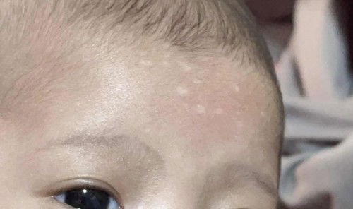 หน้าผากน้องเป็นแบบนี้คืออะไรคะ?