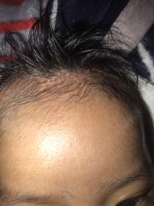 ลูกน้อย2เดือนมีไขบนหัว