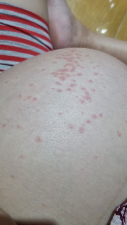 Gatal2 dan muncul ruam merah di perut saat hamil 33w