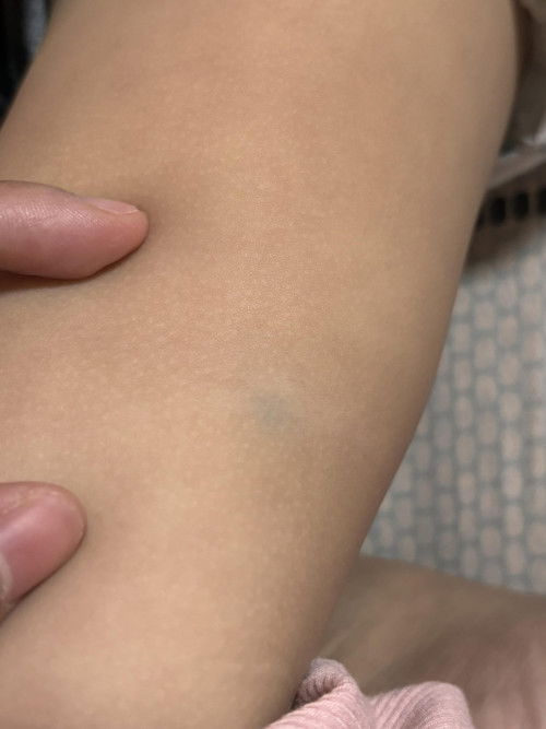 small green lump sa 2years old leg