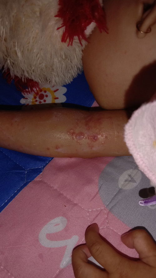 Bintik bintik ditangan kaki seperti ruam