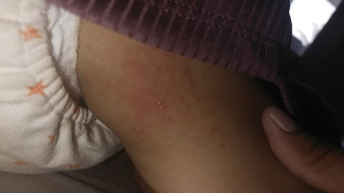 Cacar air atau bukan?