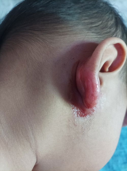 Alergi anting-anting