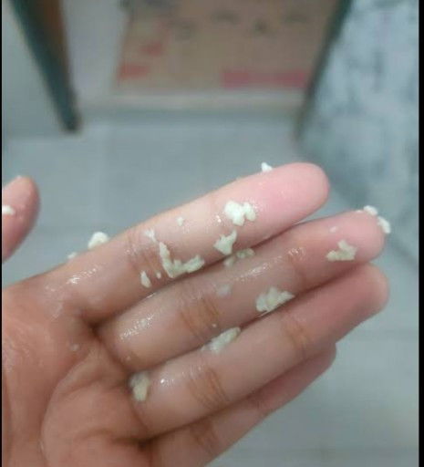 ท้อง34วิคมีอาการตกขาวคัน