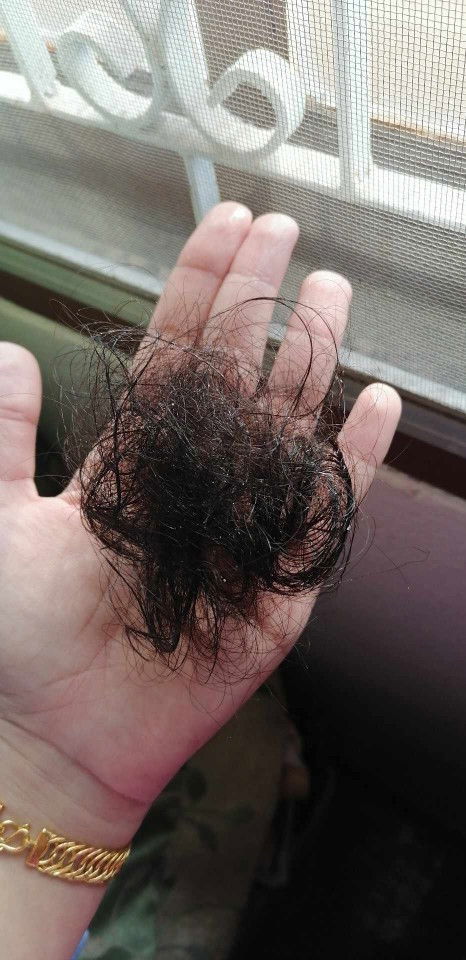 ผมร่วงหลังผ่าตัดคลอด