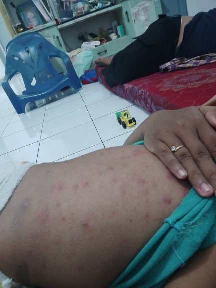 Bentol bentol merah sprti jerawat besar  di bagian blakang