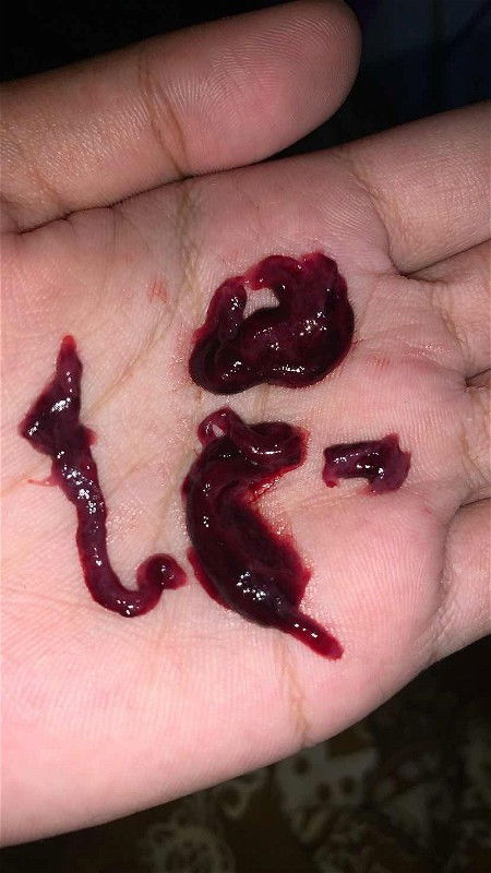 5 WEEK 2 DAY KELUAR GUMPALAN DAN DARAH