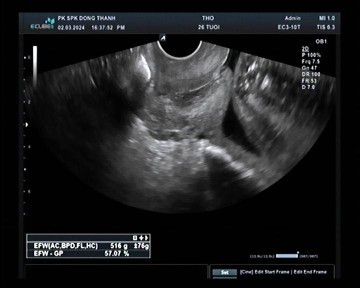 Em bầu 22w mà bs bảo bị hở tử cung ngoài 30mm . Có mom nào từng bị giống em không ạ