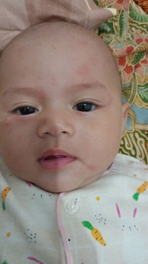 Merah merah di pipi bayi