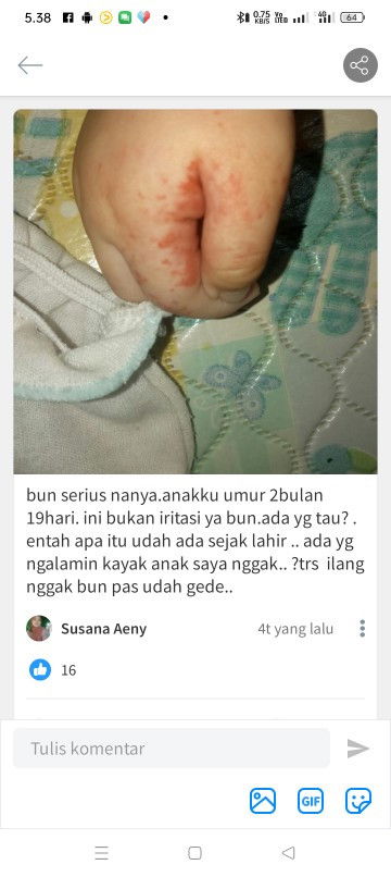 Mengenai tanda lahir warna merah pada bayi