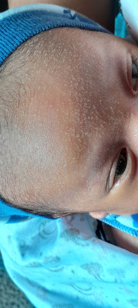 Mau nanya bunda kalau bintik berair apa obatnya iy