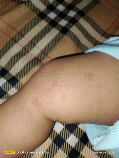 Cacar air diusia 9bulan