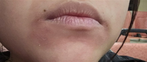 Red, bumpy and dry (a little itchy) skin around mouth area