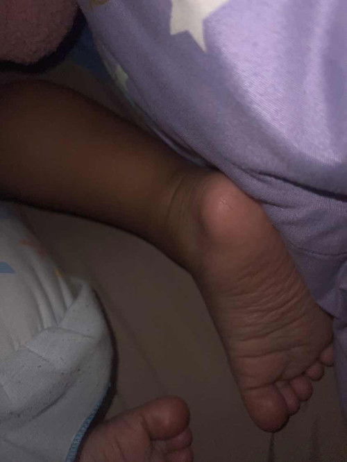 ลูกส้นเท้าแตกเหมือนผู้ใหญ่