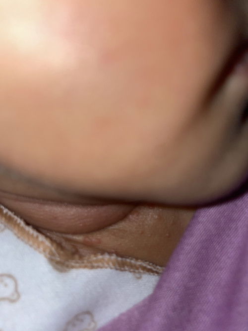 Bintik merah berair dileher