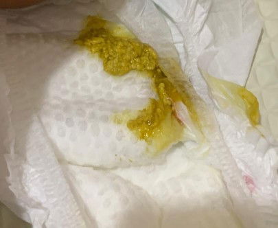 Tahi cair macam ni normal atau cirit birit