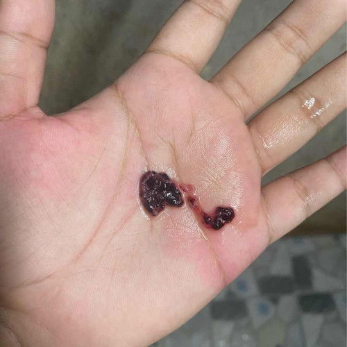 เลือดออกเเบบนี้สรุปคือเเท้งใช่ไหมคะ😭