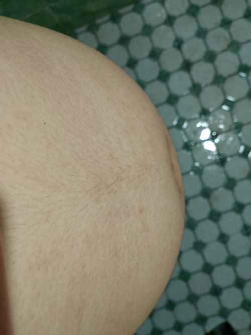 เป็นผื่นที่ท้อง