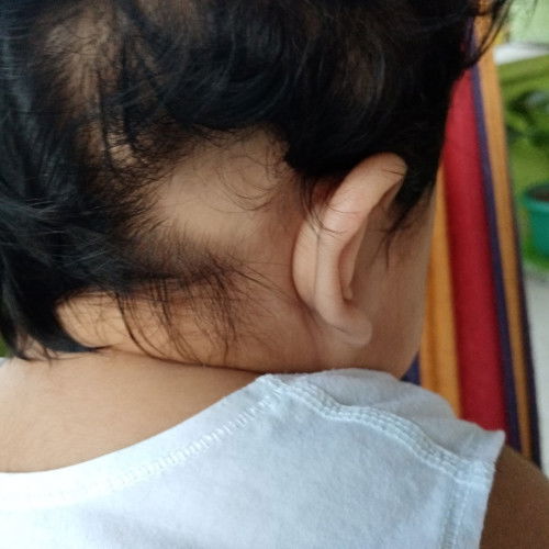 Alopecia baby going 6 months