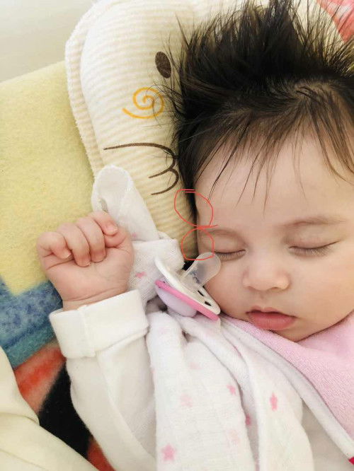 ผ่าตัดซีสต์ที่ใบหน้าเด็ก