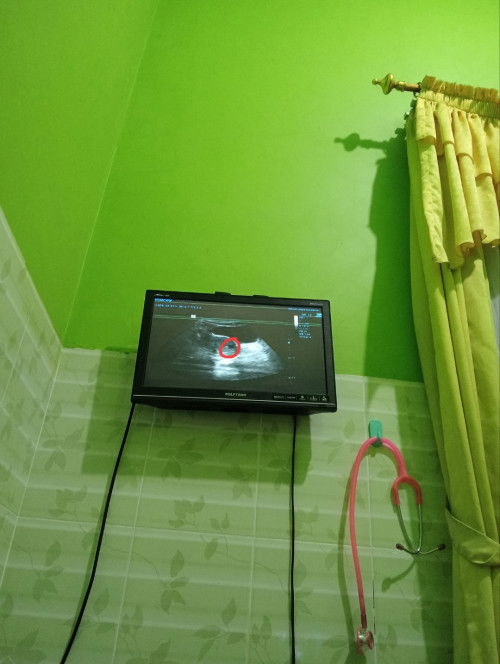 Bun aku Hamil 6 Minggu tp di USG kelihatan kantong ? Blm ada janin nya,ada yg prnh ky aku ga bun?