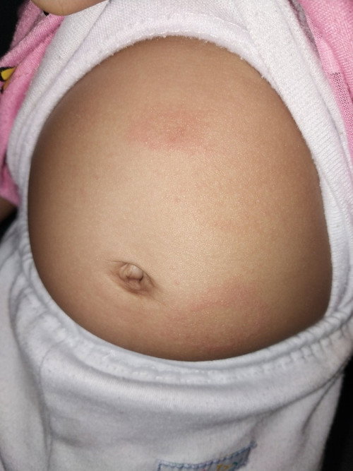 Merah merah di perut