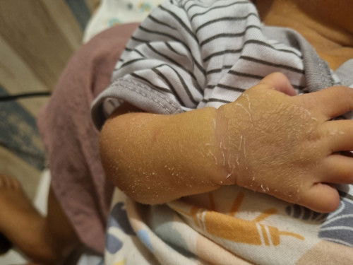Kulit kering bayi New born