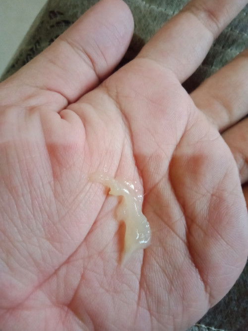 Putih putih keluar dr mis V