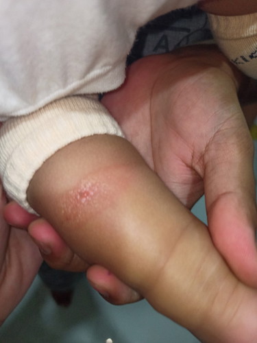 Skin rash?