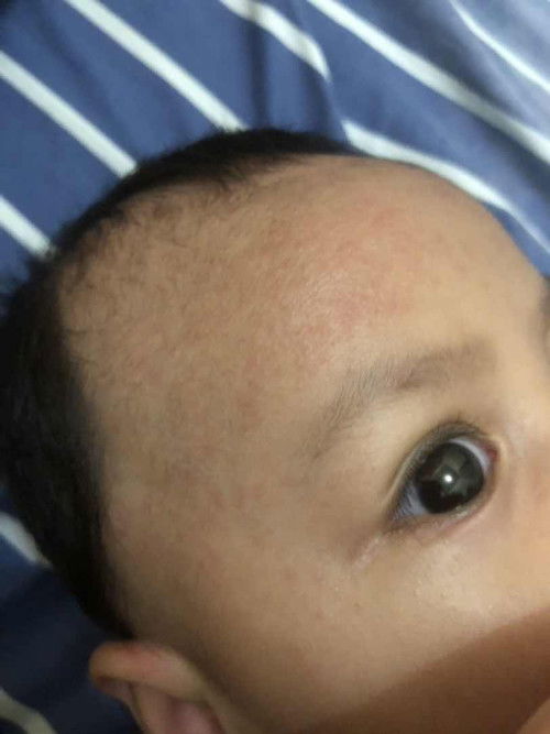 merah merah di wajah